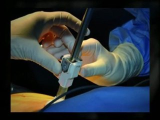 Le robot chirurgical téléoperatoire