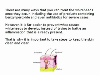What Causes Whiteheads