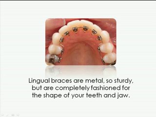 Lingual Braces Orthodontists in Grand Rapids
