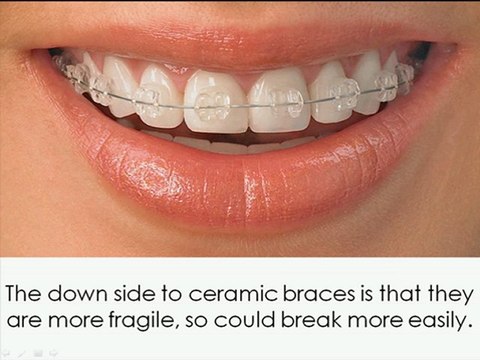 Ceramic Braces Orthodontists Grand Rapids
