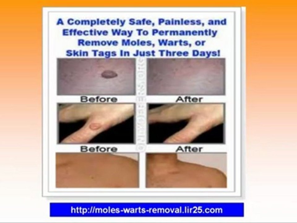 How to Remove Skin Moles - How To Remove A Mole - Home Wart Removal