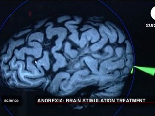 Anorexia: Estimulacion magnetica transcraneal (TMS)