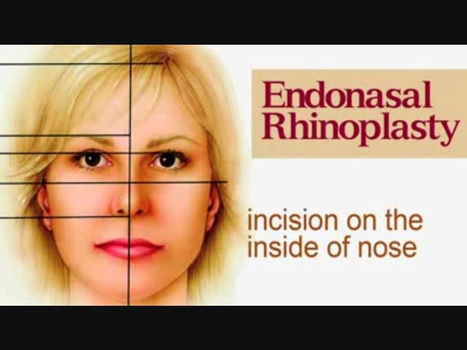 Austin Plastic Surgery - Surgical Procedures such as Mid-Face Lift, Forehead/Brow Lift, and Large Ear Reduction!