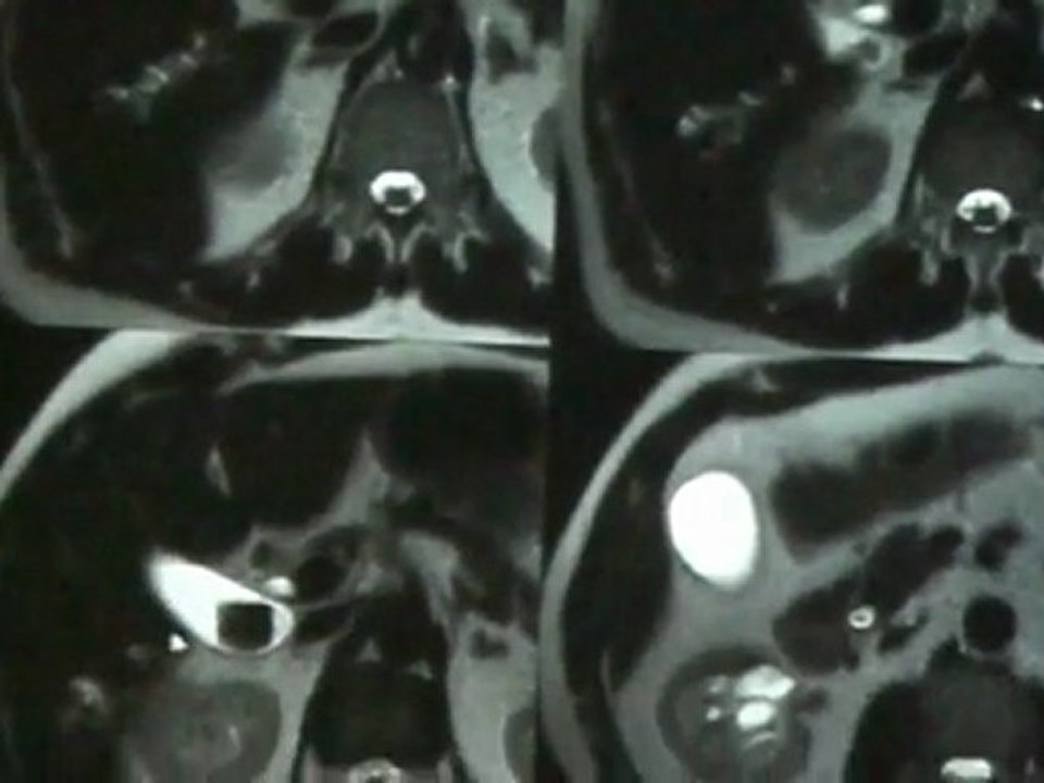 LEWIN HEPATIC NODULES 2010