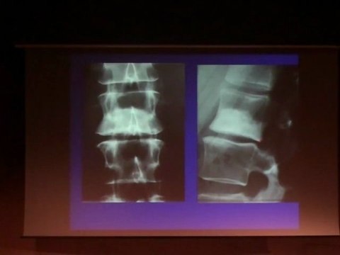 LAREDO Vertebral Tumors and Pseudotumors Part 2 Sclerotic 2010