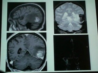 HERAN Sudden Headache - What you must not Forget