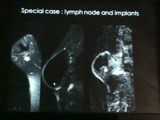 BALLEYGUIER PITFALLS IN BREAST MRI 2011