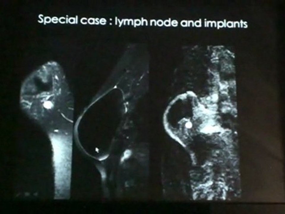 BALLEYGUIER PITFALLS IN BREAST MRI 2011