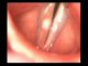 VOCALAB cordes vocales avec pathologie 1