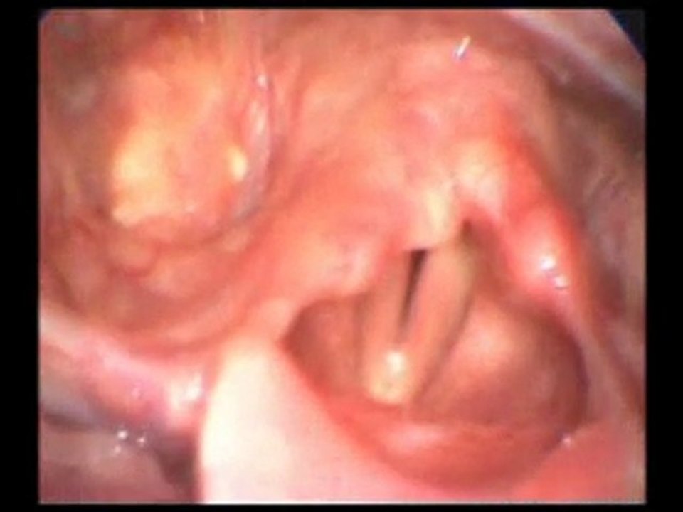 VOCALAB cordes vocales avec pathologie 2