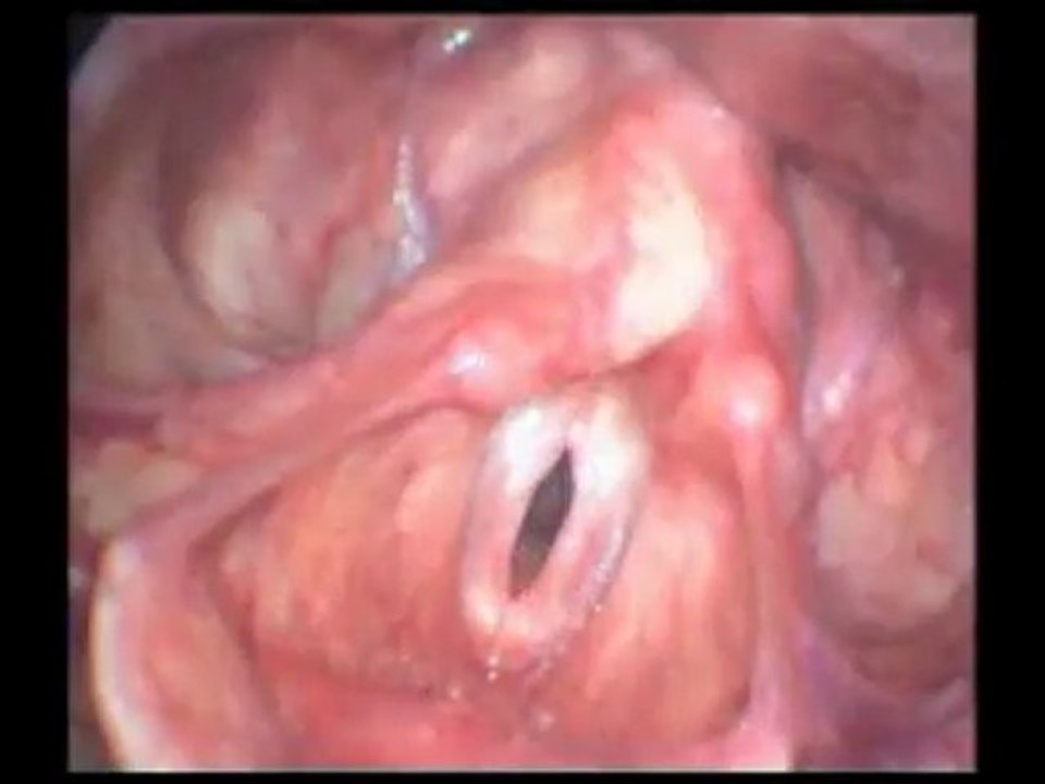VOCALAB cordes vocales avec pathologie 3
