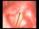 VOCALAB cordes vocales normales 2