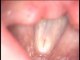 VOCALAB cordes vocales normales 3