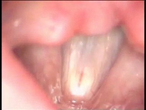 VOCALAB cordes vocales normales 3