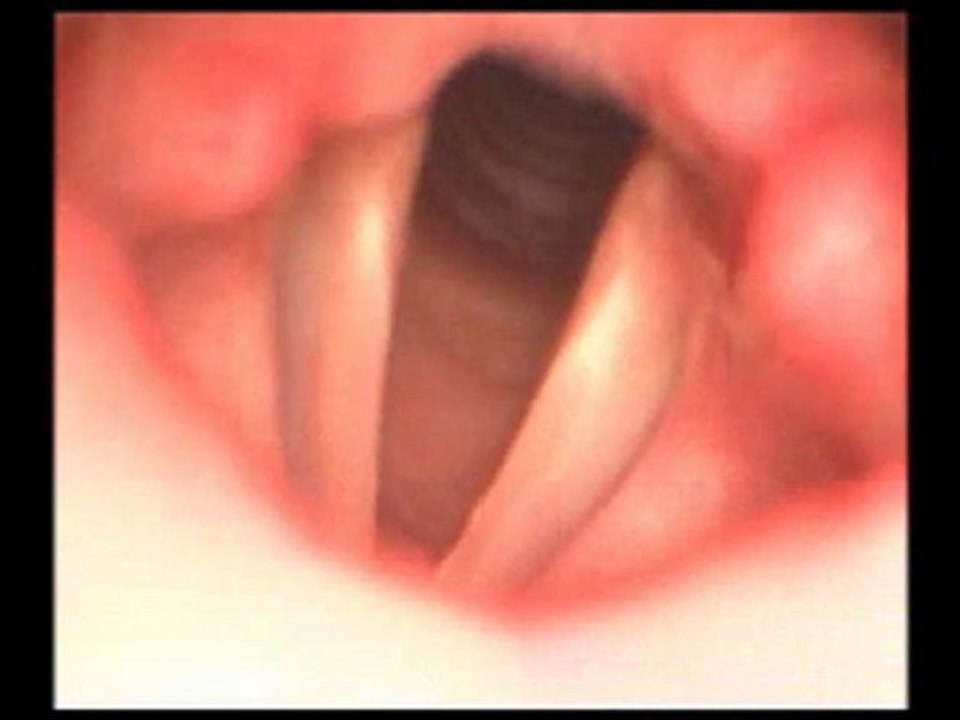 VOCALAB cordes vocales normales 1