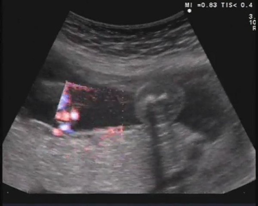 linfedema degli arti inferiori