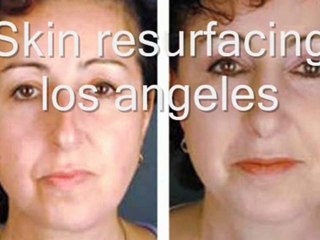 Stretch mark removal los angeles