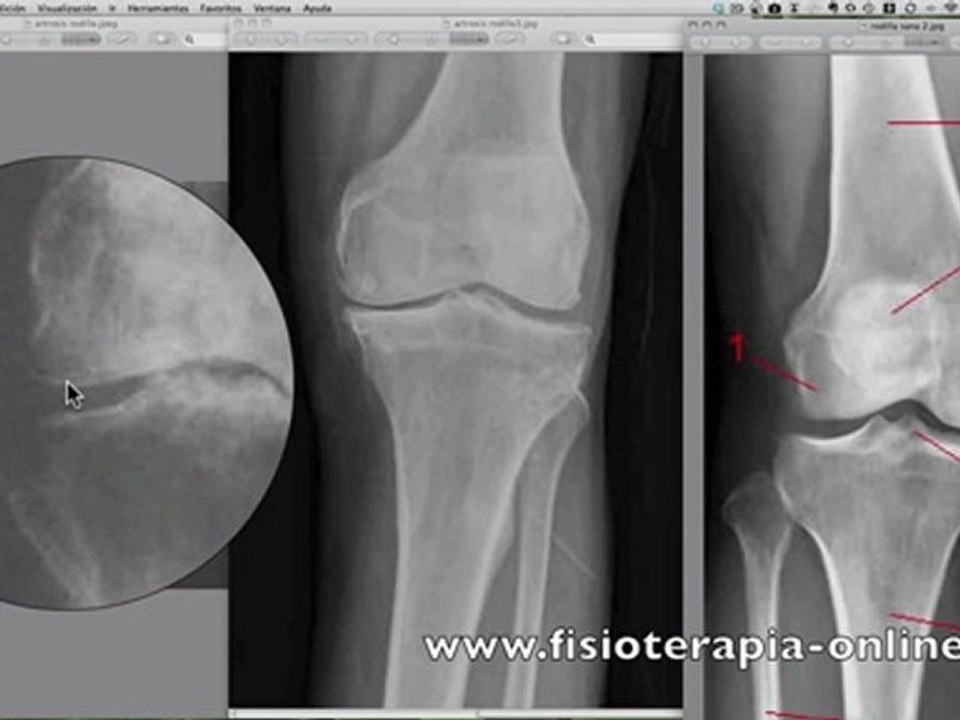 Artrosis de rodilla o gonartrosis. Signos radiológicos.