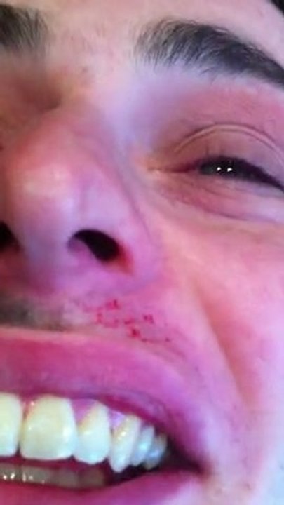 Adam Craig's Movember Moustache Waxing