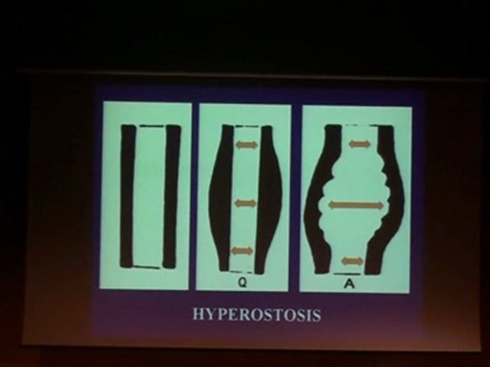 LAREDO BONE PSEUDO TUMORS Part 2 2010
