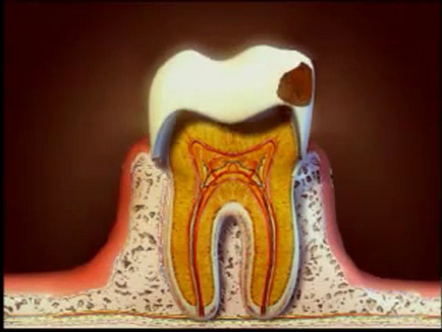 Caries et soins des caries