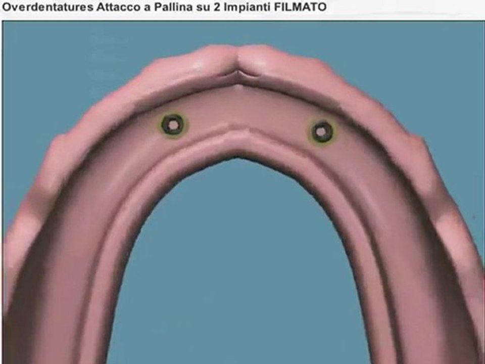 Prothèse complète sur 2 implants