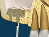 Chirurgie Sinus lift avec 3 implants dentaires
