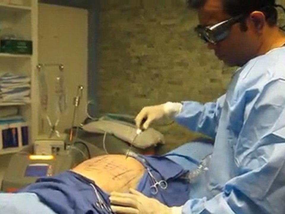 SmartLipo Laser Liposuction- Los Angeles County-Orange County-Riverside County-San Bernardino County-Inland Empire-Anaheim-Fullerton-Beverly Hills-Pasadena-Burbank-Hollywood-Cerritos-Long Beach-Irvine-Costa Mesa-Orange-Brea-Whittier-Pomona-Chino-Fontana