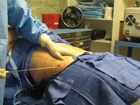 SmartLipo Laser Liposuction- Los Angeles County-Orange County-Riverside County-San Bernardino County-Inland Empire-Anaheim-Fullerton-Beverly Hills-Pasadena-Burbank-Hollywood-Cerritos-Long Beach-Irvine-Costa Mesa-Orange-Brea-Whittier-Pomona-Chino-Fontana