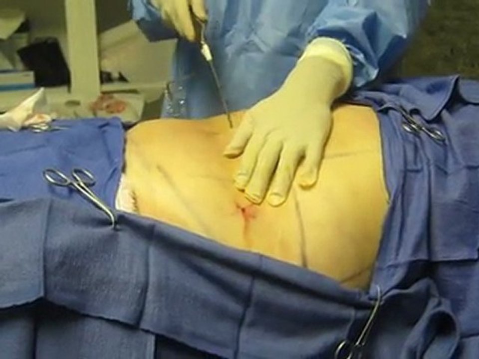 SmartLipo Laser Liposuction- Los Angeles County-Orange County-Riverside County-San Bernardino County-Inland Empire-Anaheim-Fullerton-Beverly Hills-Pasadena-Burbank-Hollywood-Cerritos-Long Beach-Irvine-Costa Mesa-Orange-Brea-Whittier-Pomona-Chino-Fontana