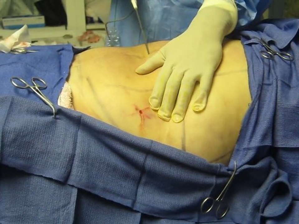 SmartLipo Laser Liposuction- Los Angeles County-Orange County-Riverside County-San Bernardino County-Inland Empire-Anaheim-Fullerton-Beverly Hills-Pasadena-Burbank-Hollywood-Cerritos-Long Beach-Irvine-Costa Mesa-Orange-Brea-Whittier-Pomona-Chino-Fontana
