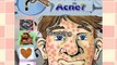 What Causes Adult Acne