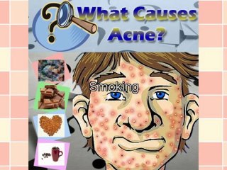 What Causes Adult Acne