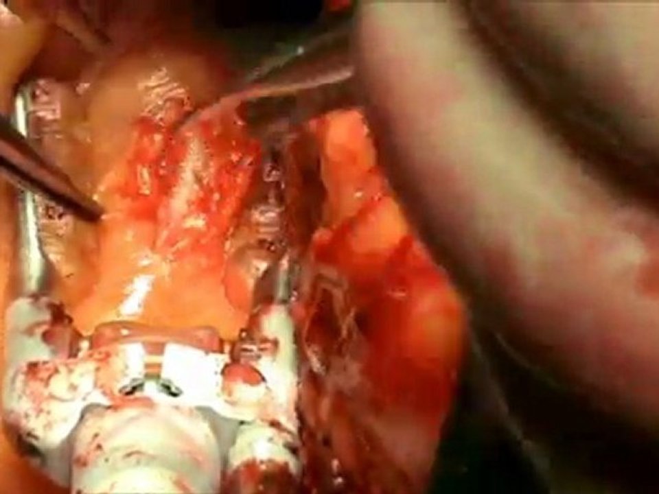 RCA Bypass - Op. Dr. Mahmut Akyıldız