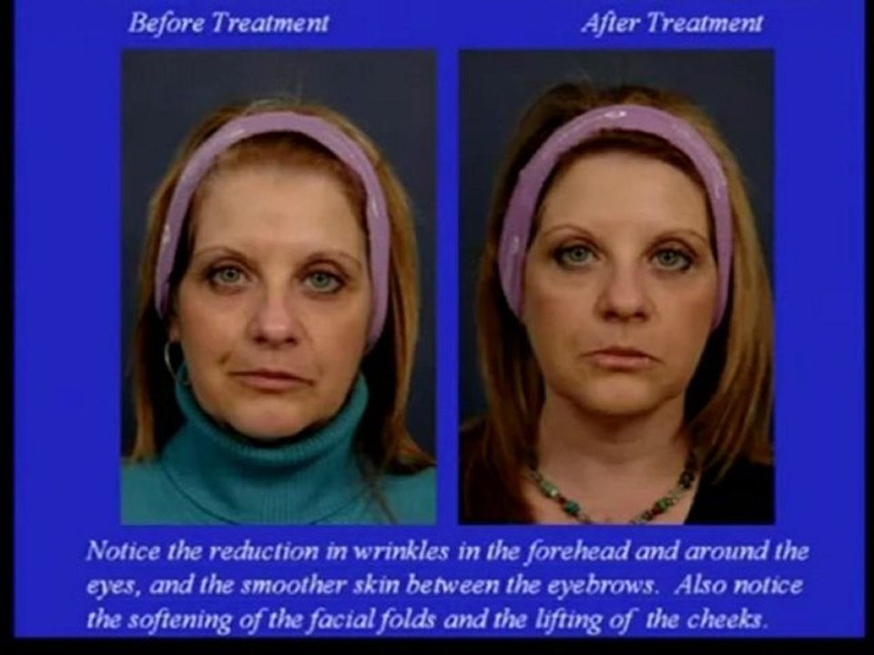 Botoks Video , Botoks Nasıl yapılır