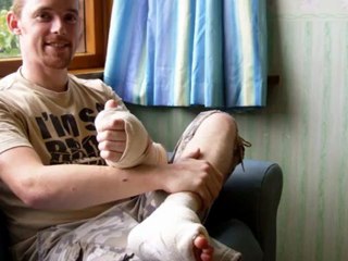 Un homme se fait greffer un orteil à la place du pouce