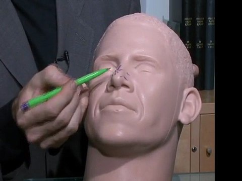 Best Rhinoplasty Nose Job Surgery in San Francisco Bay Area