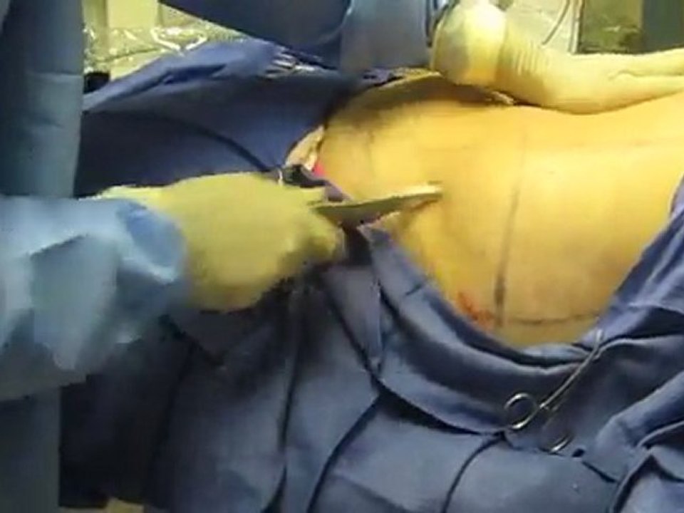 Laser Liposuction-SmartLipo-Abdomen-Flanks-Los Angeles-Orange County-Riverside-Pasadena-Covina-Brea-Chino Hills-Pomona-Whittier-Rowland Heights