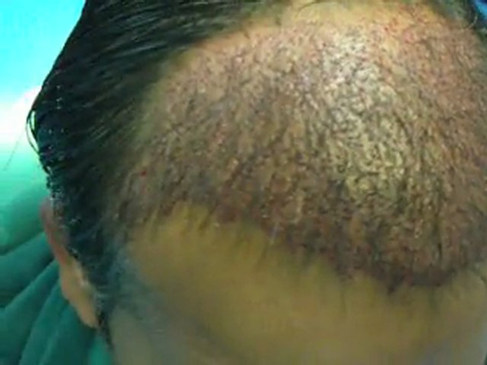 Hårtransplantation på FUE & Strip metoden, Hair Transplant & Hair Restoration Sweden