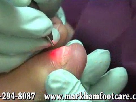 Laser Therapy for Fungal Toenails - Chiropodist in East Markham, Unionville and Stouffville, ON