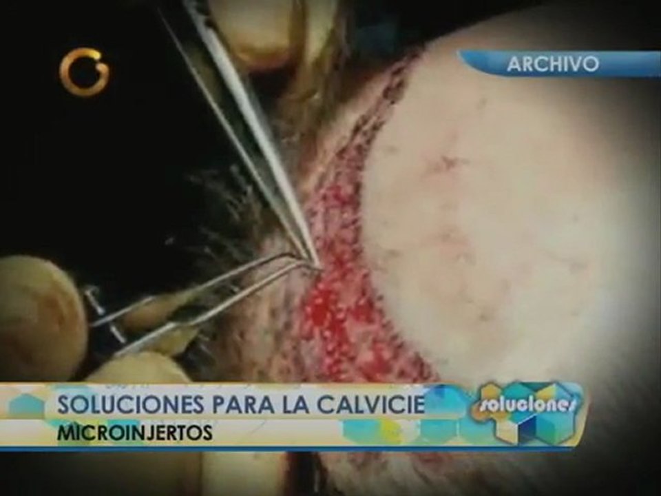 Soluciones para los calvitos