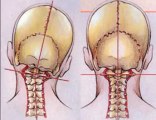 Relief Back & Neck Pain, Sciatica, Disc problems