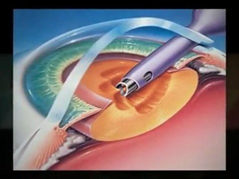 Cataract Surgery/West Springfield, MA/413-781-6352