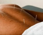 Santa Monica Acupuncturist- Find the best Santa Monica acupuncture services