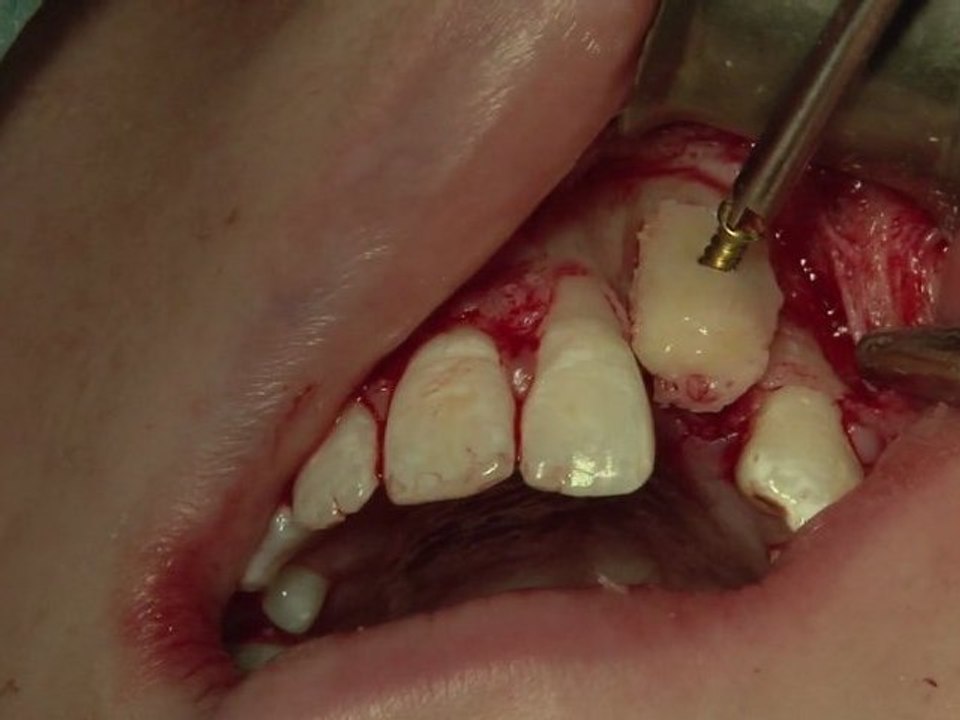 greffe osseuse / prélèvement ramique / implant dentaire