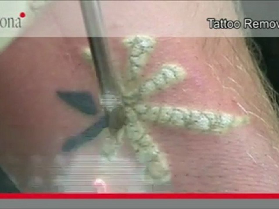 enlever les tatouages au laser