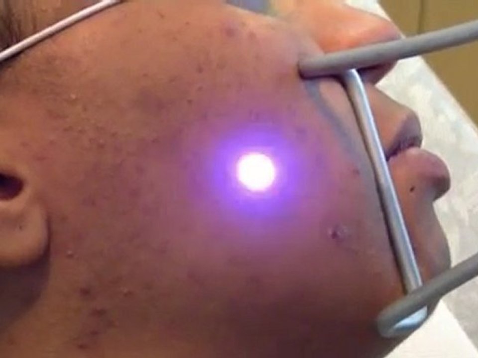 acné au laser sur peau noire