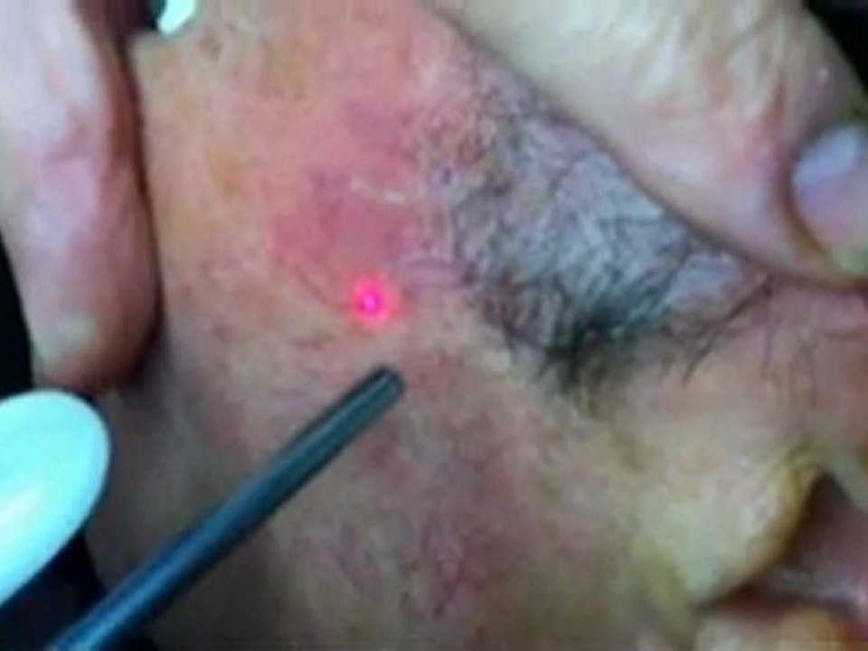 couperose visage et nez au laser Nd Yag