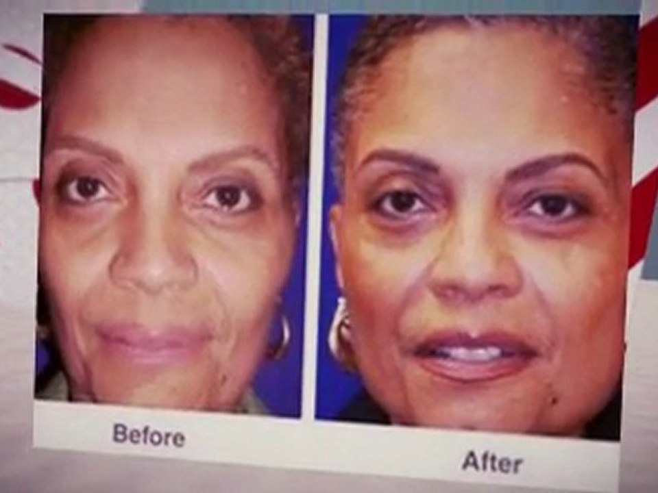 Facial Fat Grafting By Best Plastic Surgeron Las Vegas - Dr. Troell