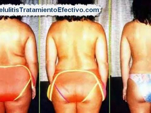 Combatir Celulitis [Como quitar la celulitis de las piernas rapido]